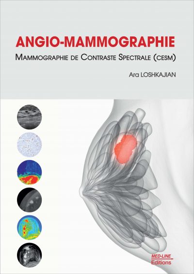 Angio Mammographie